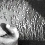 Smallpox